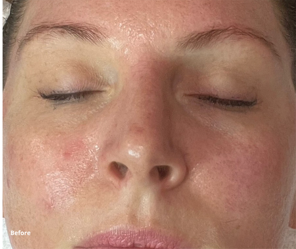 Before Treatment