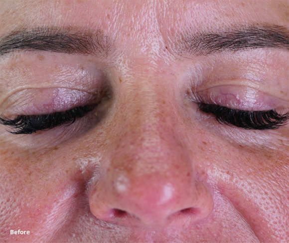 Before Treatment