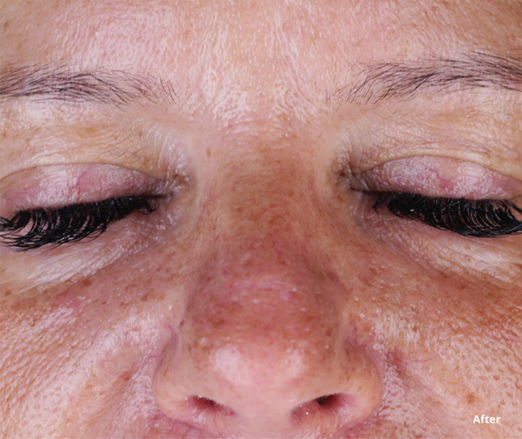 After Treatment