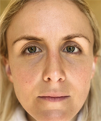 Before Treatment