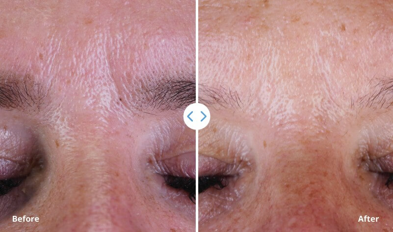 Results after 4 weekly treatments of Exosome+V. 