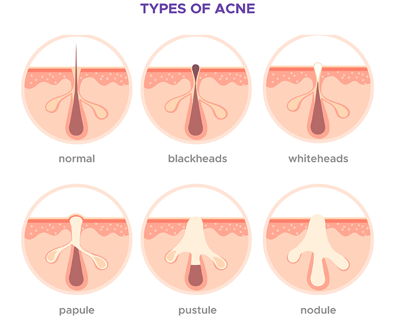 The Buildup Beneath the Surface 
